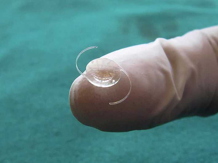微流體眼壓感測器和白內障手術的晶體一起植入