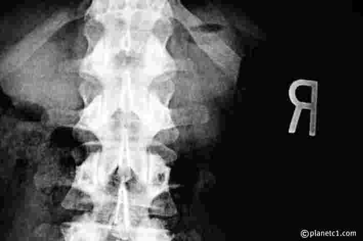 脊椎的X光影像