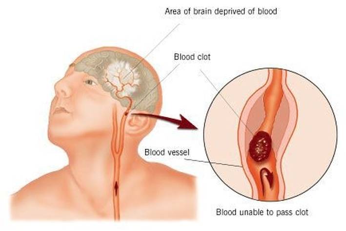 導管進入腦部取出血塊，患者恢復佳。