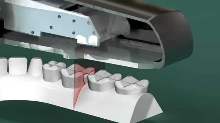 金屬中心開發的口掃機，雷射掃描牙齒示意圖。