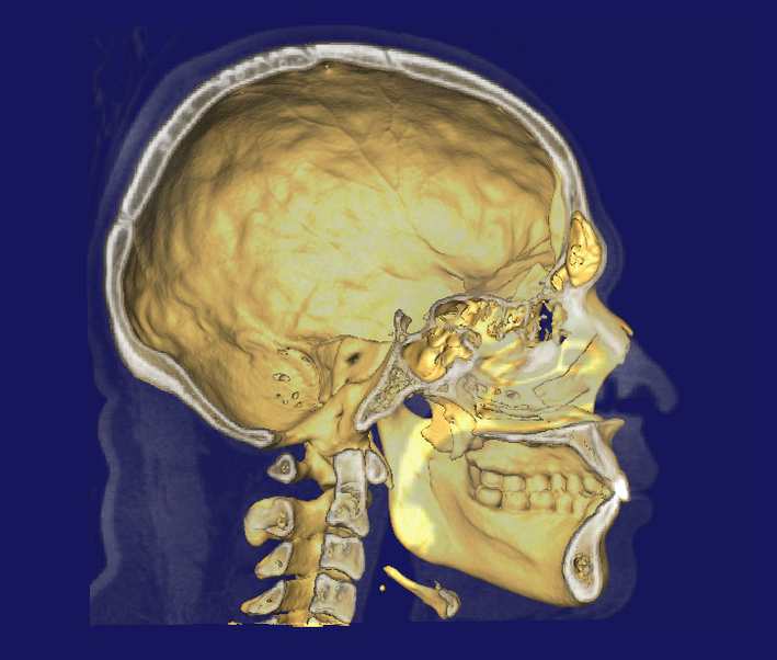電腦斷層(CT)影像建立的3D模型。