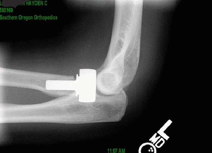 常見的鈦金屬的醫療植入物，此為手肘關節部位。