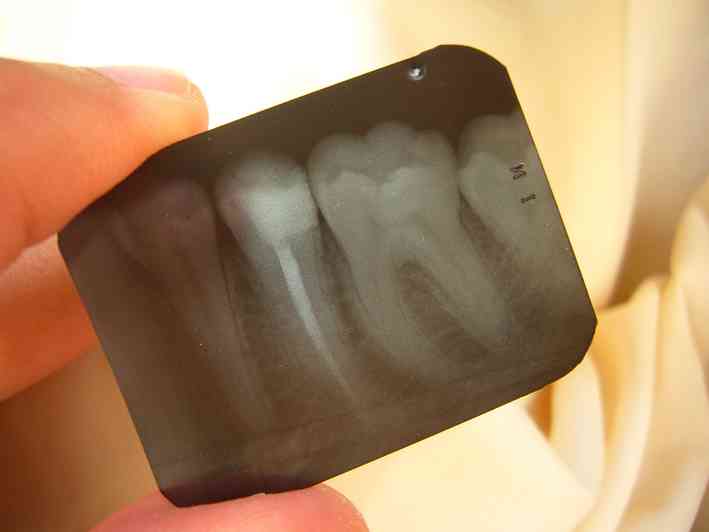牙齒的根管治療的X光片顯示。