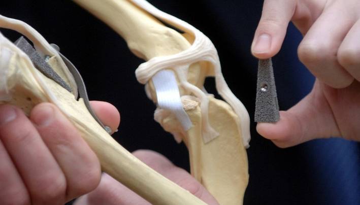 3D列印的骨科植入物。當需要小而巧時，如何局部加入纖維增加強度?