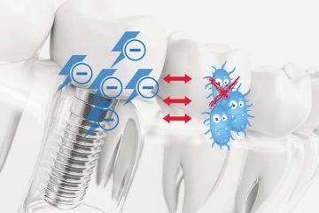 你的植牙抗菌嗎?材料新應用產生負電荷抗菌
