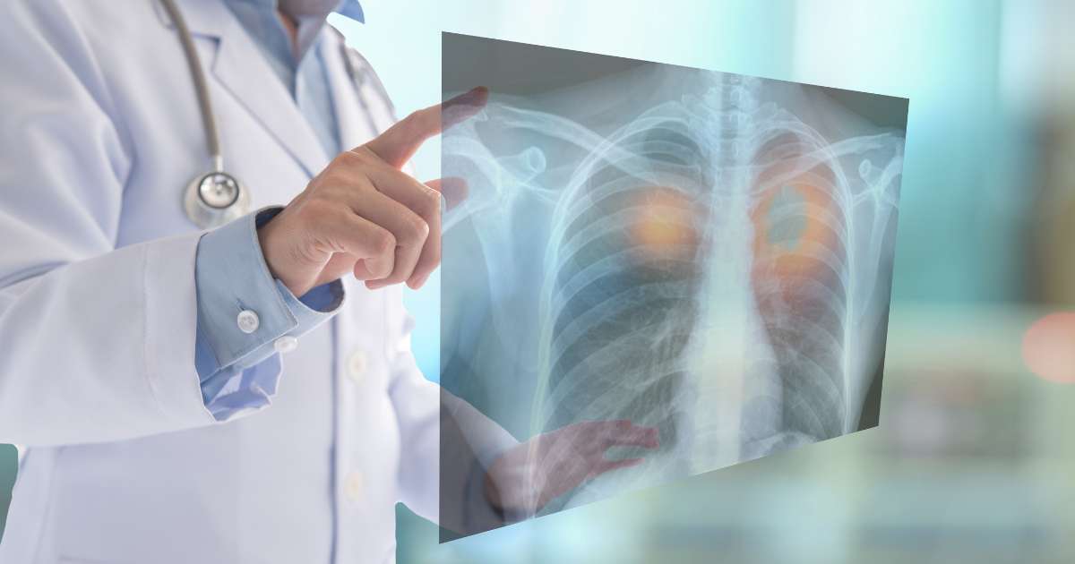 吸入型生物感測，尿液就能檢測早期肺癌?
